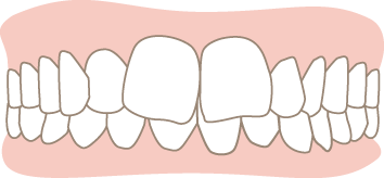 上顎前突（じょうがくぜんとつ ）