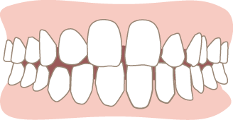 空隙歯列（くうげきしれつ）